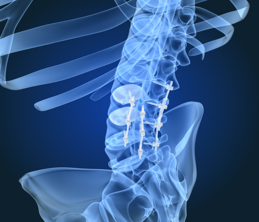 X-ray showing medical precision parts, like surgical screws in someone's back