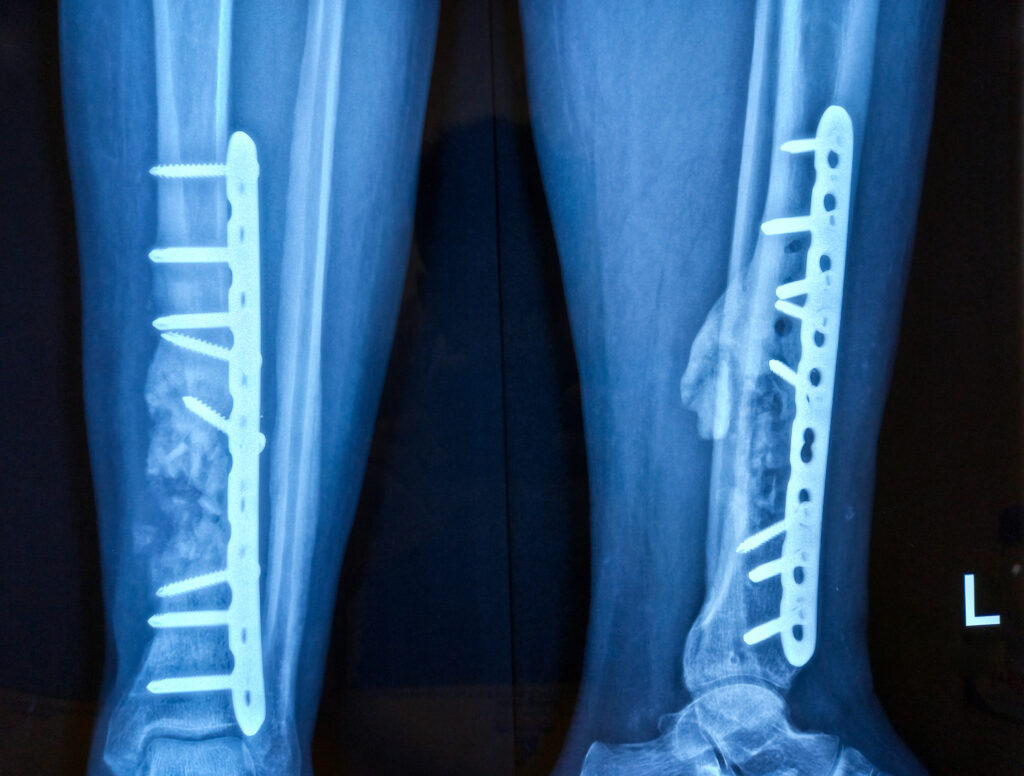 An X-ray of two legs reveals medical implants in the lower calf, highlighting how titanium in medical implants plays a crucial role in surgical procedures.