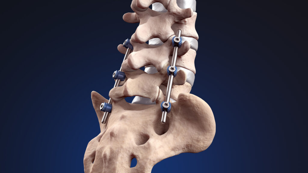 Image of a spine with medical-grad precision parts implanted for support